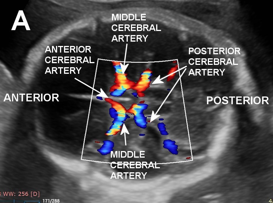 Peak Systolic Blood Flow In The Mca